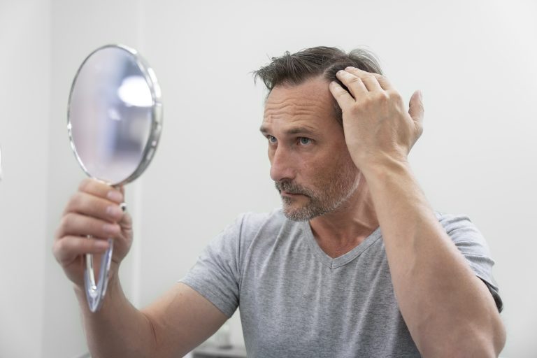 Male hair loss in 2025: A new era of real, evidence-based treatments