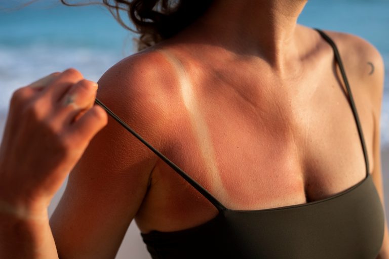 Why do some people tan while others burn?