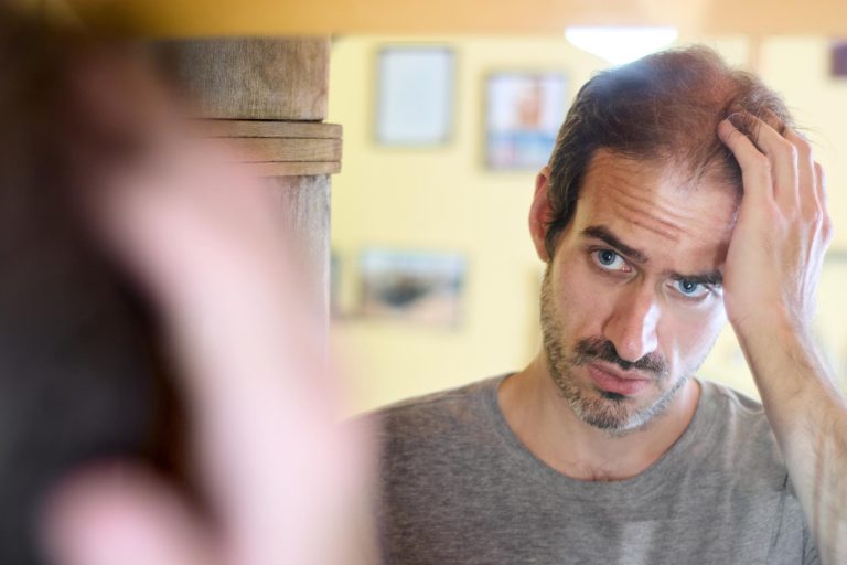Why genetics play a major role in hair loss
