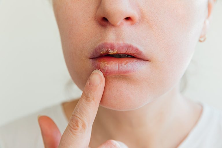 The real reason your lips keep getting chapped