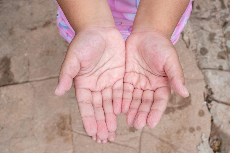 Why Do Our Fingers Wrinkle in Water?