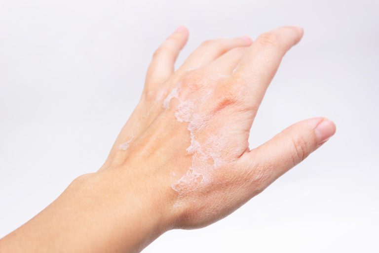 Why Do Our Hands Feel Drier in Autumn?